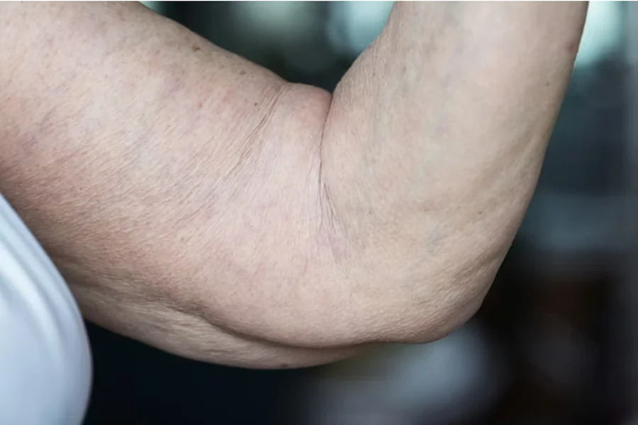 The Role of Surgery in Treating Flabby Arms