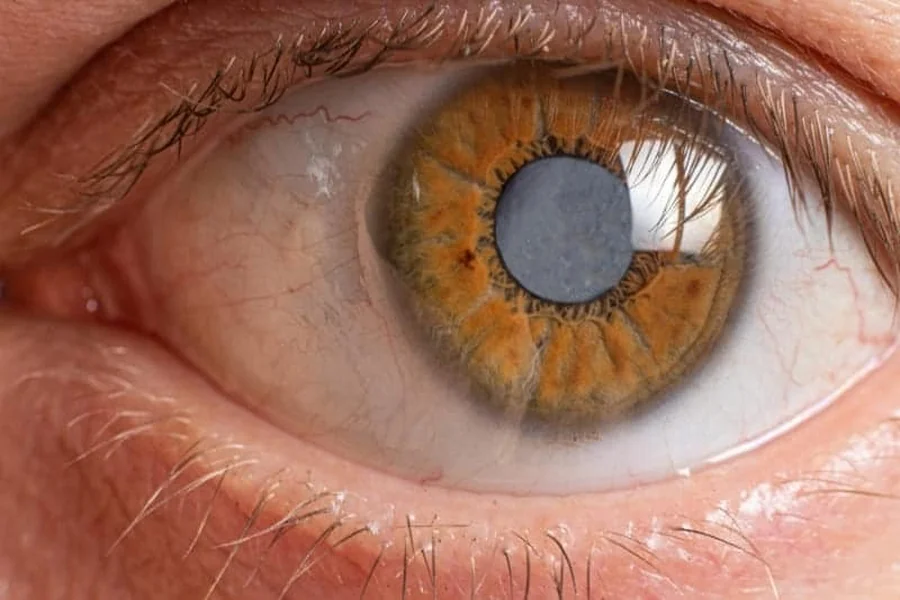 Cataract Treatment Without Operation What Is Possible and What Is Not