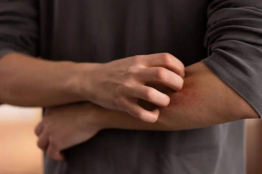 Itchy Skin No Rash